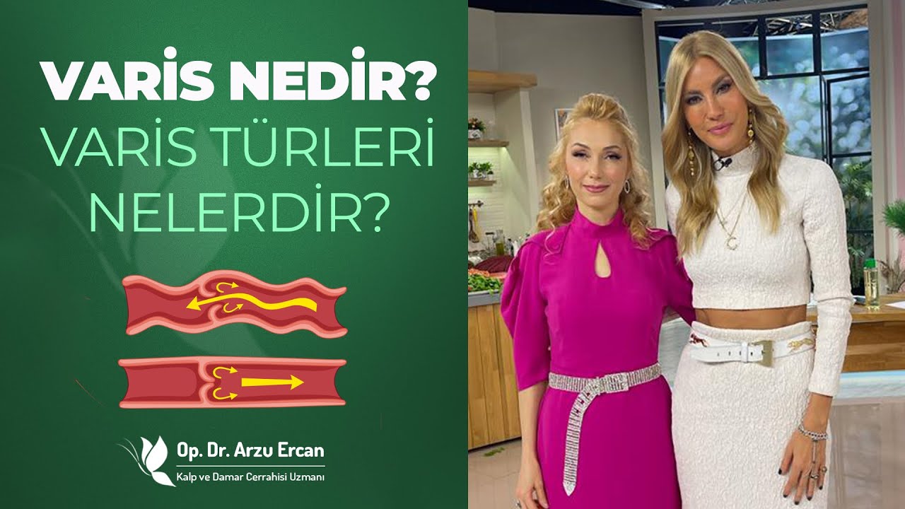 Varis Nedir? Varis T&uuml;rleri Nelerdir? | Op. Dr. Arzu Ercan
