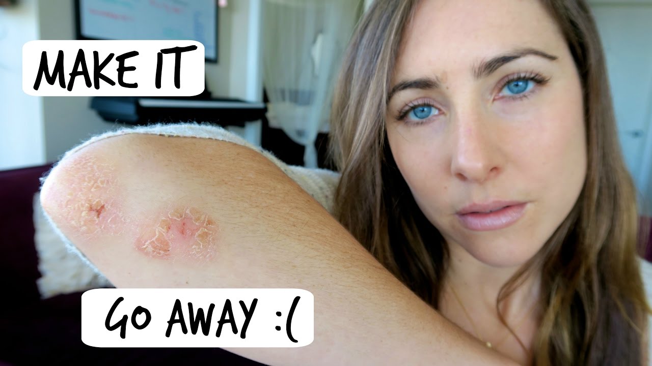 Getting serious about healing my Leaky Gut & Psoriasis // iHerb Haul