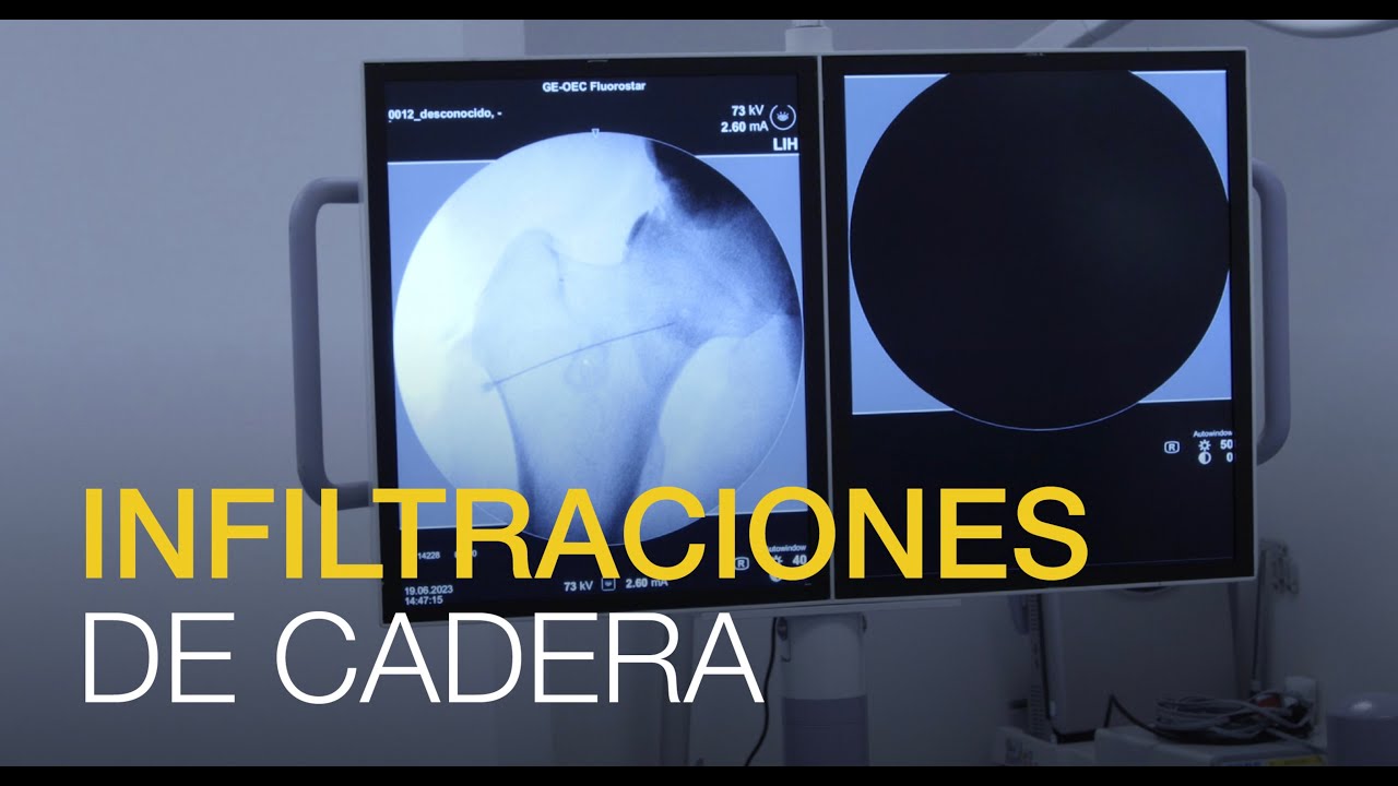 ¿Cómo se realizan las infiltraciones de cadera?