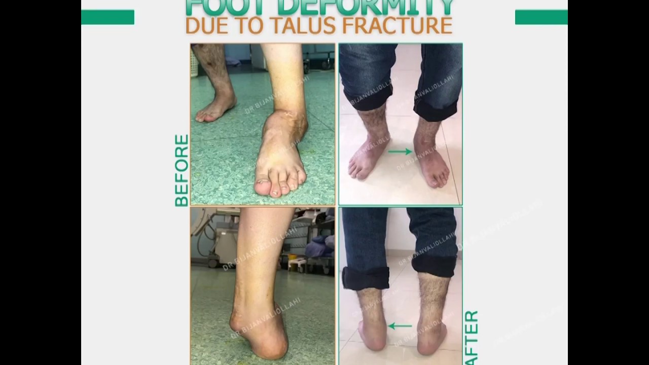 Foot deformity due to talus fracture