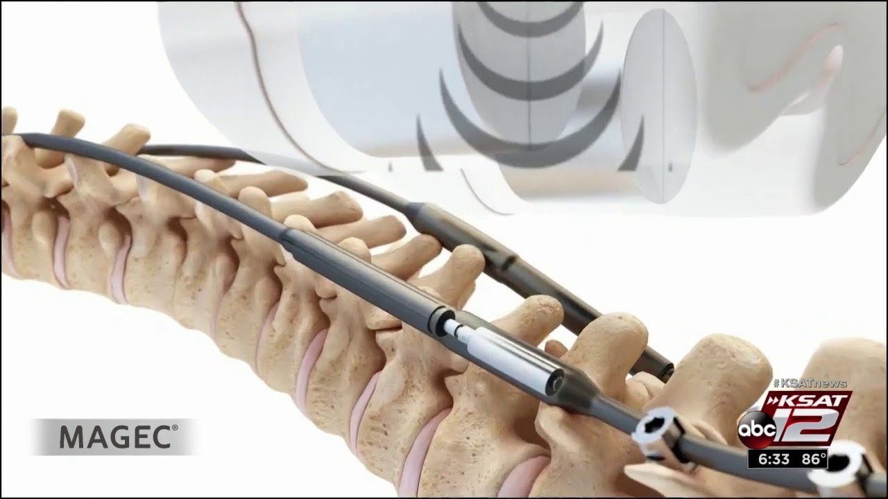 Magic magnets help lengthen spine for scoliosis patients