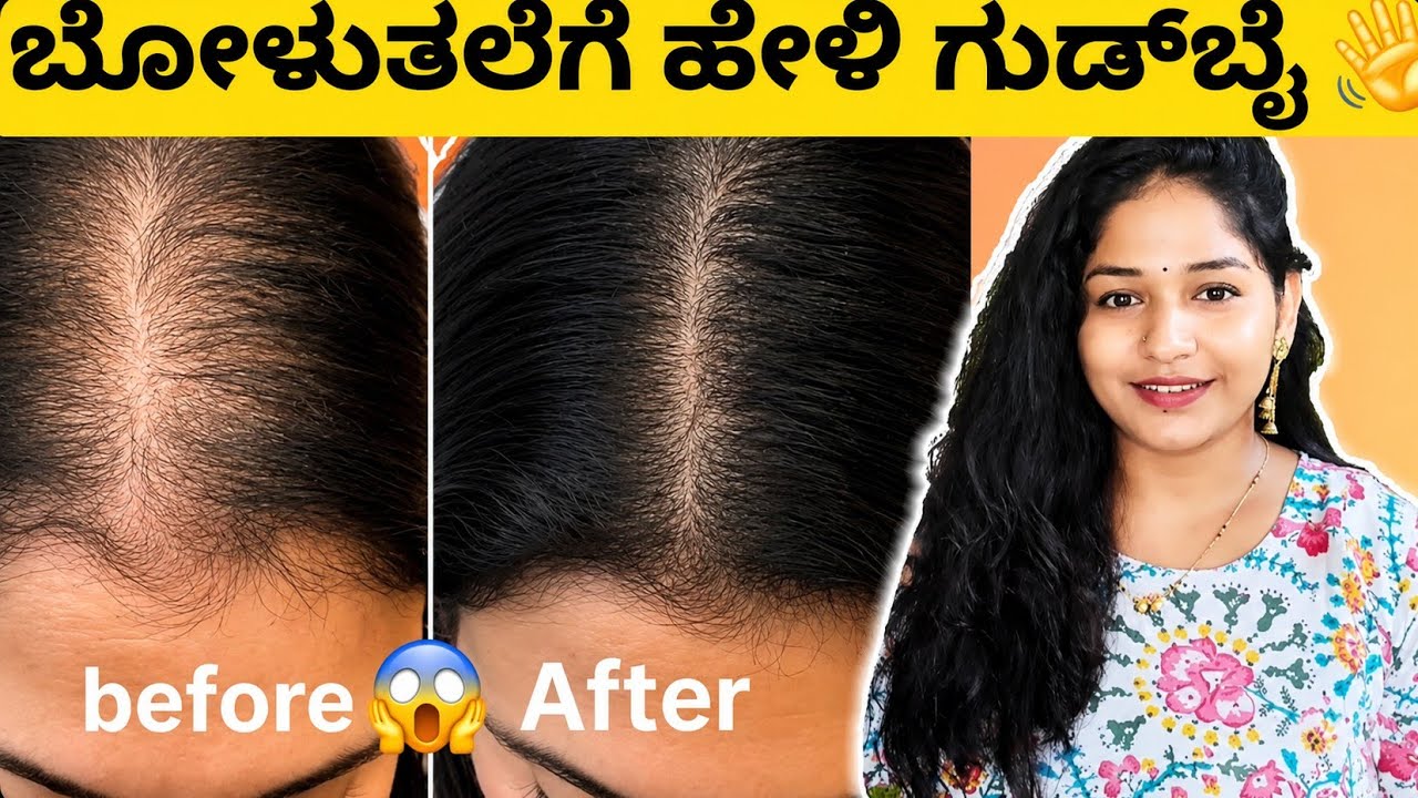 😱ಎಷ್ಟೆ ತಲೆ ಬೊಳಾಗಿದ್ರು ರಾತ್ರಿ ಹಚ್ಚಿ ಬೆಳಗ್ಗೆ ಫಲಿತಾಂಶ ನೋಡಿ! 💆‍♀️ಬಾಲ್ಡ್ನೆಸ್‌ಗೆ ಶಾಶ್ವತ ಪರಿಹಾರ 