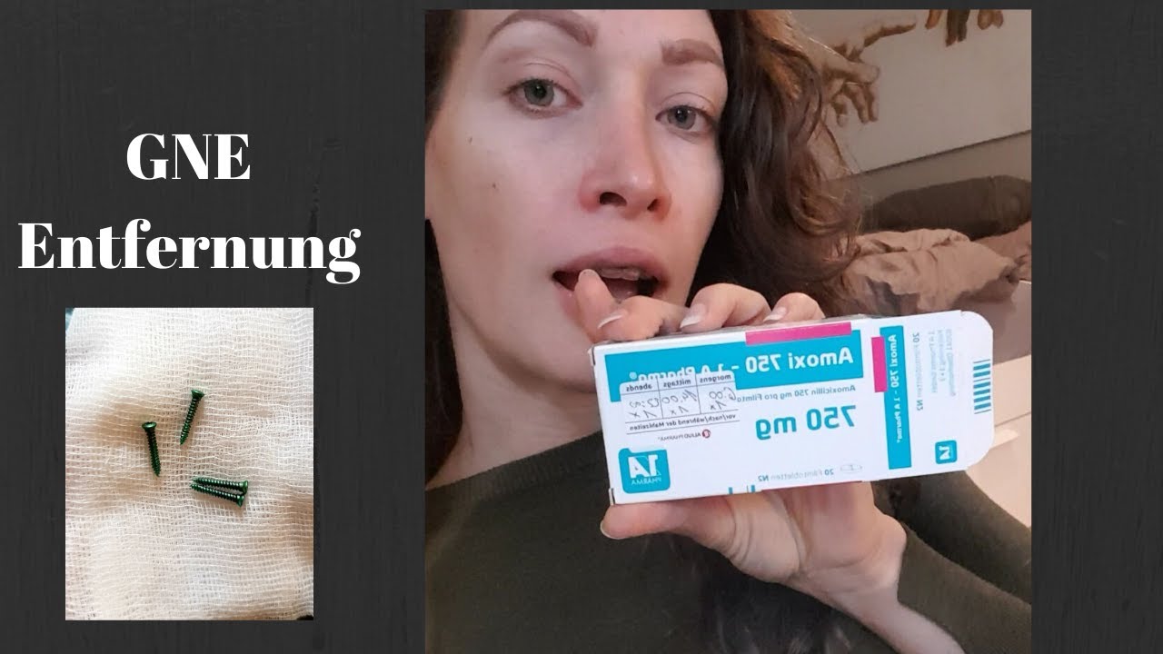 GNE Entfernung, Gaumenbügel, Schmerzen, Kiefer Op 2019