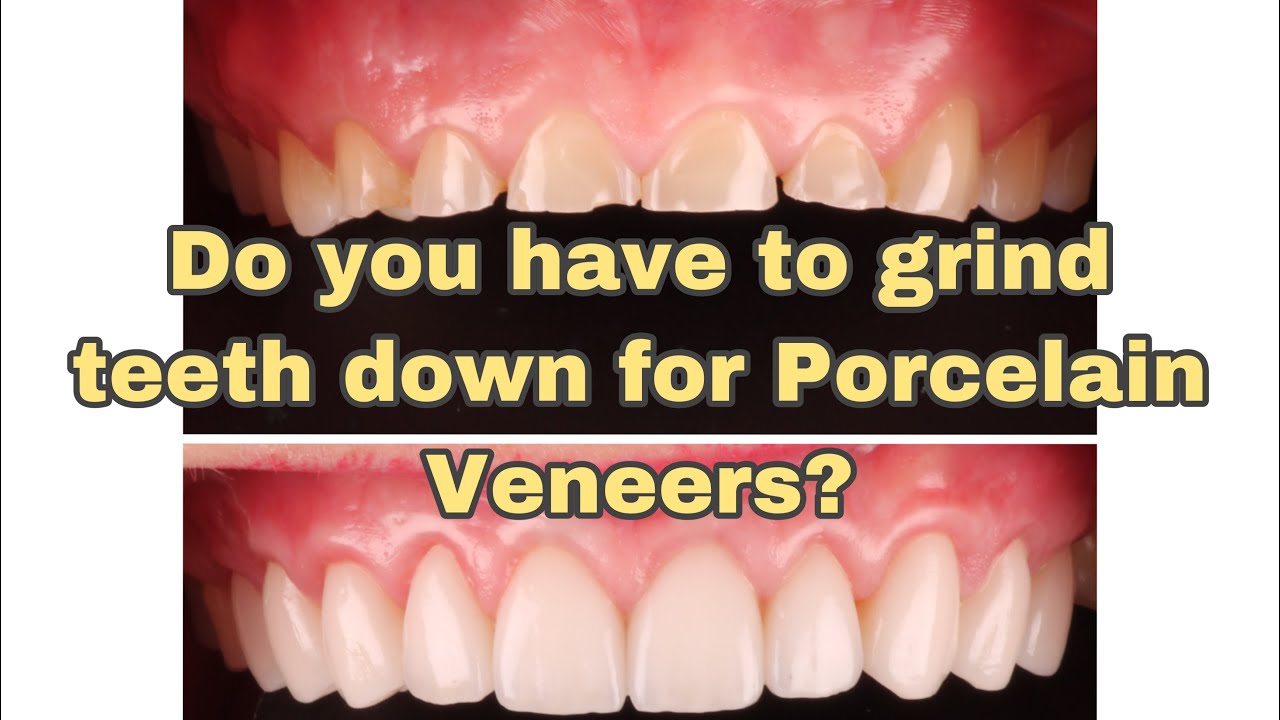 Do you have to grind / shave teeth for porcelain veneers?