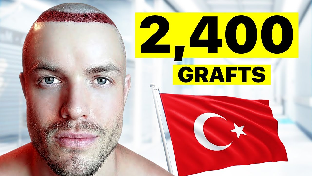 I Got A Hair Transplant In Turkey | Surgeon Reacts