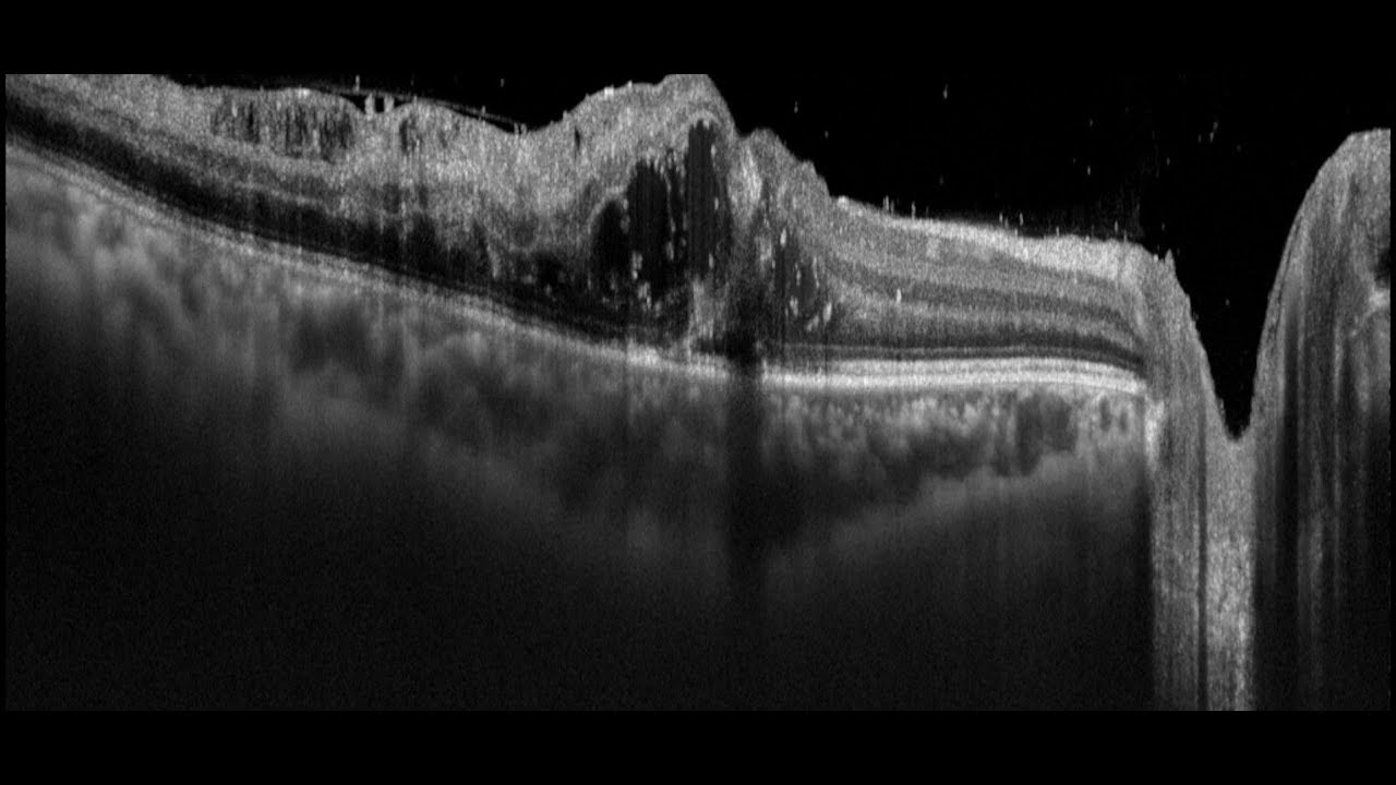 Treatment for Cystoid Macular Edema