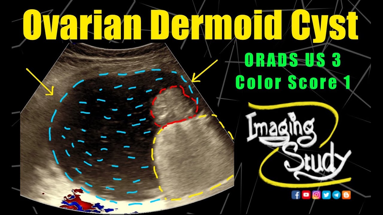 Ovarian Dermoid Cyst | Mature Cystic Teratoma | ORADS 3 || Ultrasound || Case 295