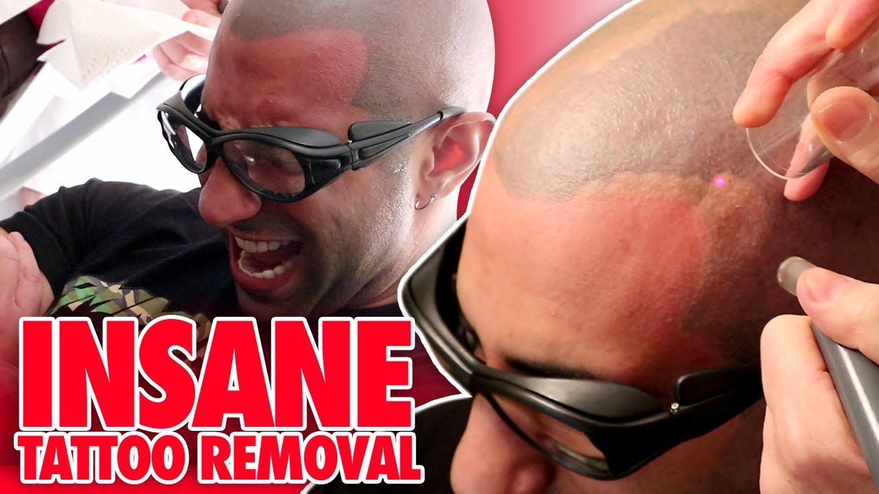 I GOT LASER TATTOO REMOVAL ON MY HEAD!