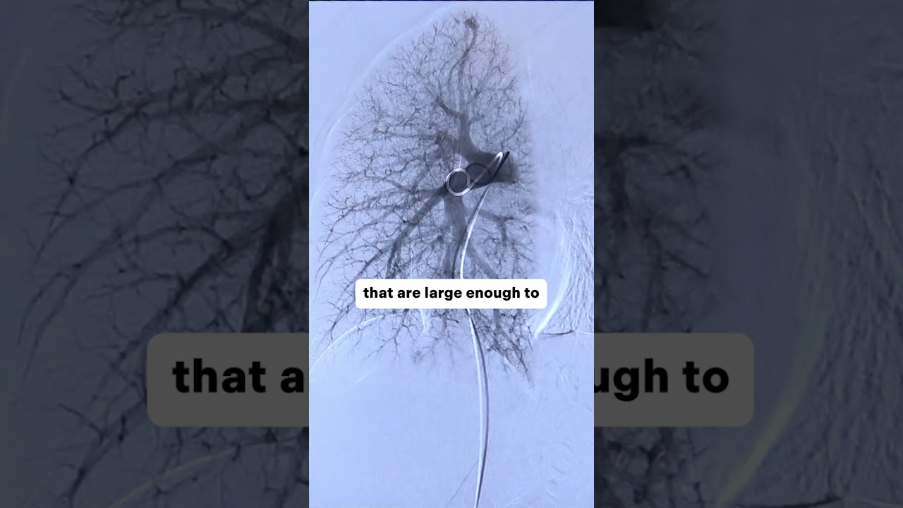 Mapping the Lung : &ldquo;Pulmonary AVM Embolization&rdquo; #meded #or #IR #surgery #lung #surgicaleducation