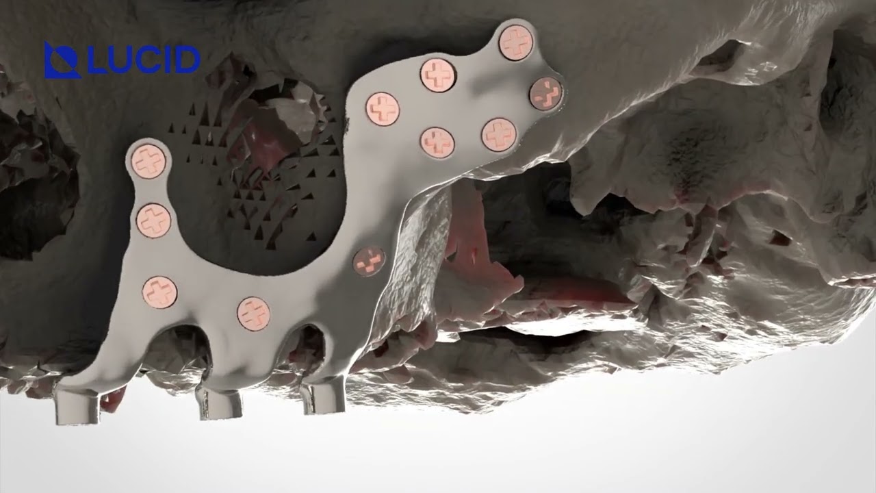 Edentulous Maxilla and Mandible Reconstruction with 3D Printed Subperiosteal Jaw Implants