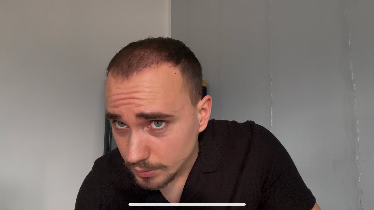 So sieht es nach fast 3 MONATEN aus! - Erfahrungen mit der PRP-BEHANDLUNG bei ELITHAIR! #3