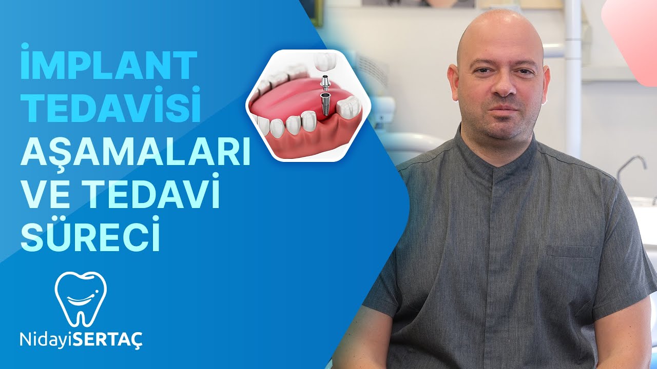 İmplant Tedavisi Aşamaları ve Tedavi S&uuml;reci