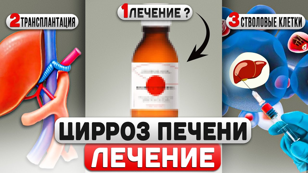 ЦИРРОЗ ПЕЧЕНИ: виды цирроза, современные методы лечения, стоимость лечения, прогноз жизни.