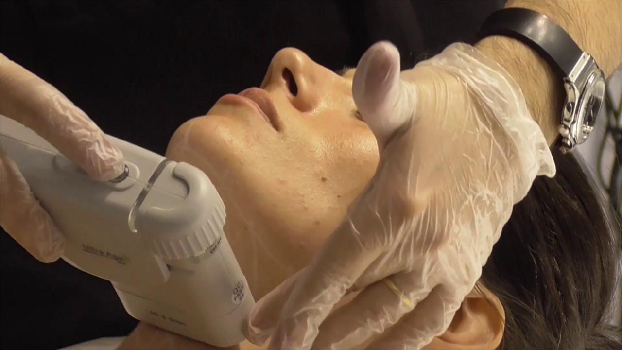 HIFU Facial - Demostración Ultralift HIFU - Cosmobeauty2017