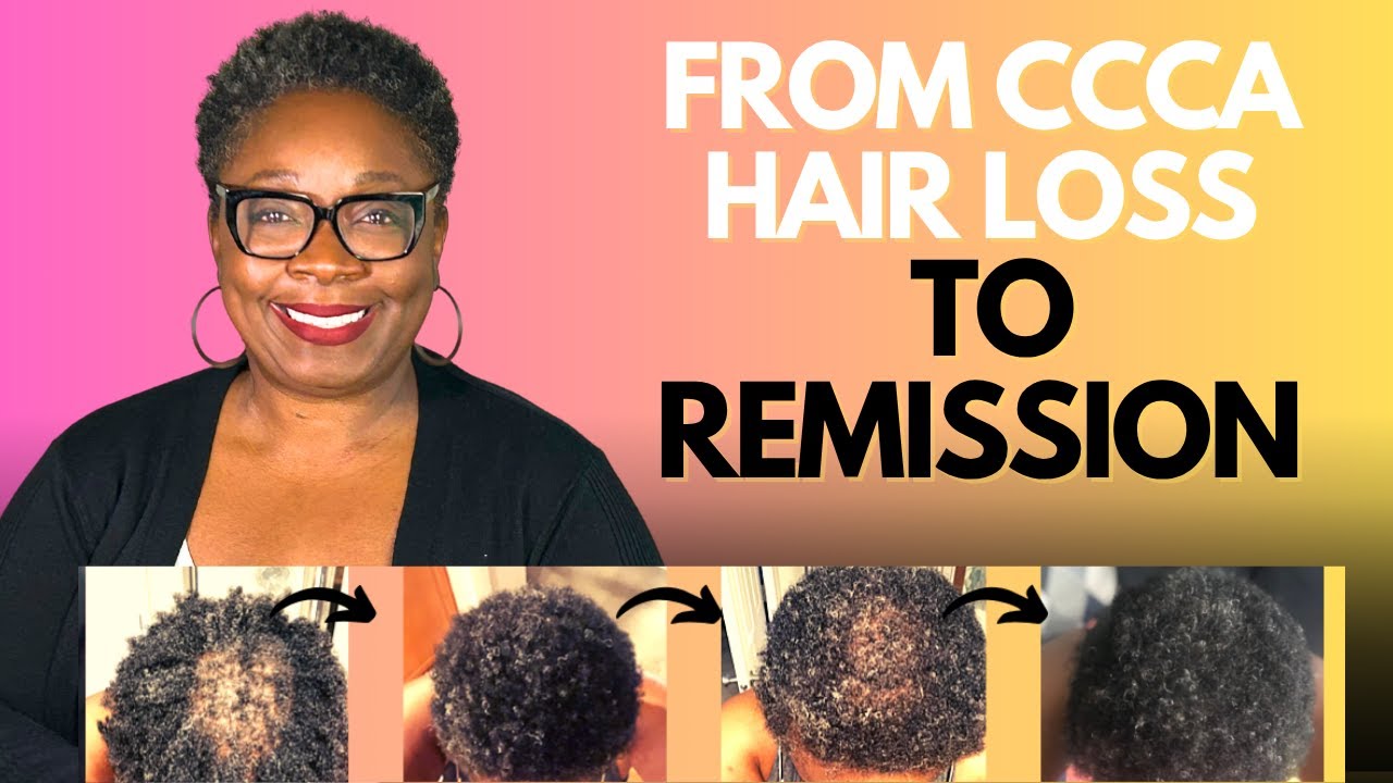 My CCCA Hair Loss Journey: 10 Things I Did To Help Find Relief + Reverse Major Hair Loss💛