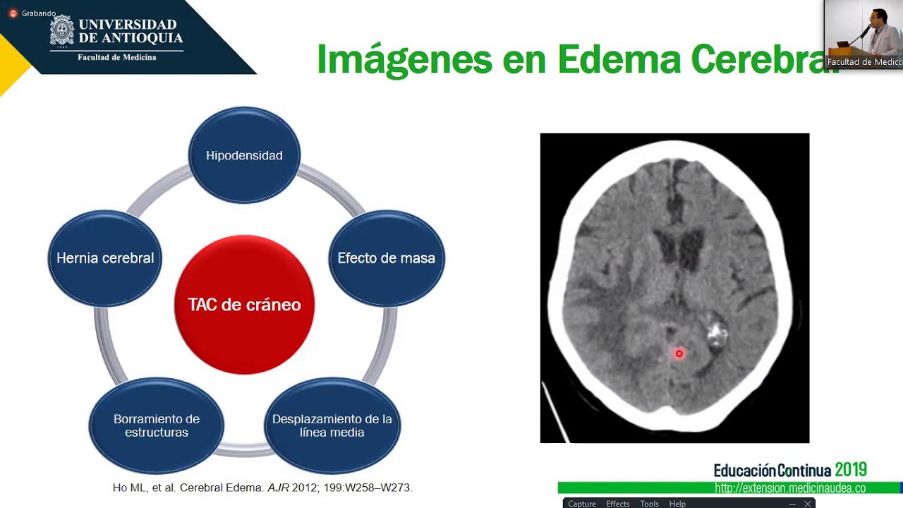 11  Edema cerebral en urgencias