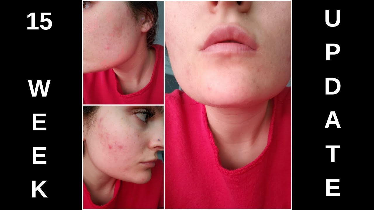 Spironolactone for Acne! 15 WEEK UPDATE! (at Lake Tahoe!) - Episode #13