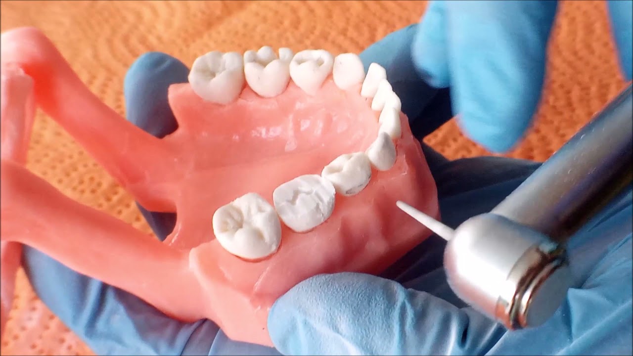 PREPARACIÓN DE CORONA ACERO CROMO Y CELULOIDE
