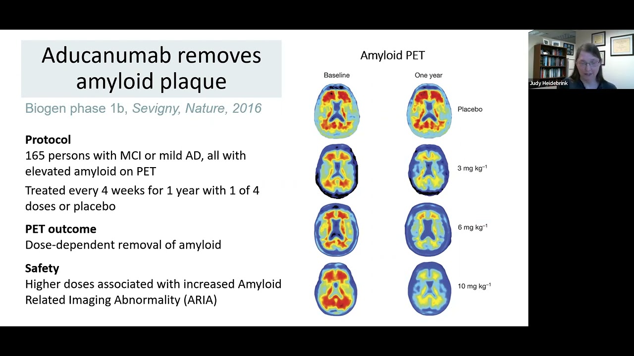 What’s New in Alzheimer’s Disease Clinical Trials?