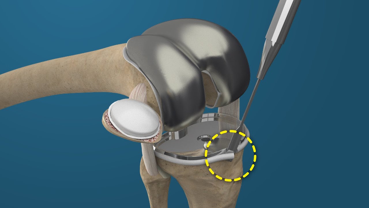 How a Human Knee is Replaced (Medical Animation)