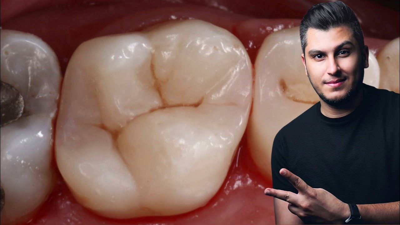 الحشوات التجميلية للأسنان الخلفية خطوة بخطوة (شرح مهم لكل طبيب)