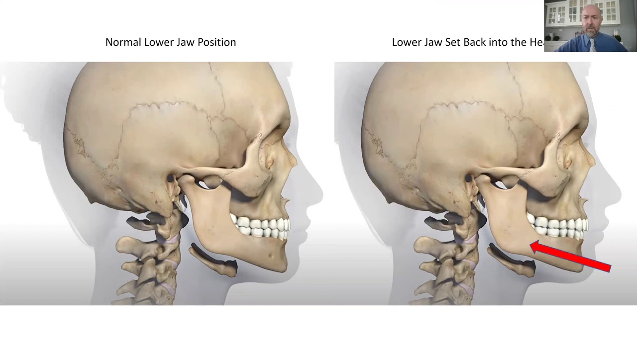 How Small Jaws Affect Your Airway And TMJs & What To Do About It