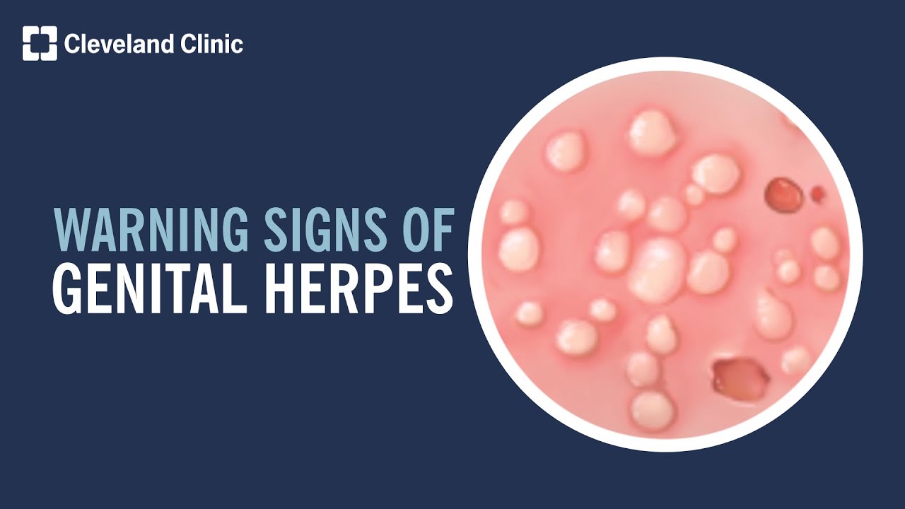 5 Warning Signs of Genital Herpes
