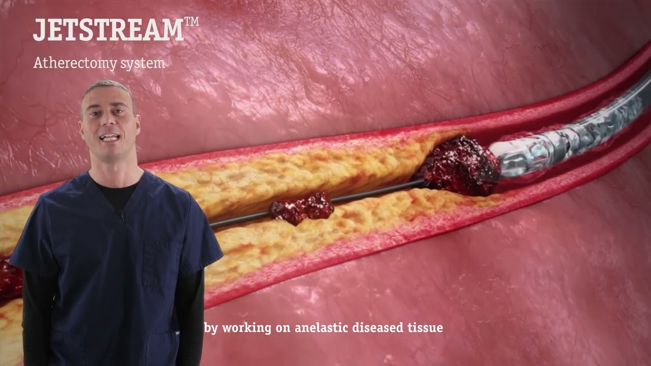Archigen Medical Devices Pills: ep. 5 Jetstream