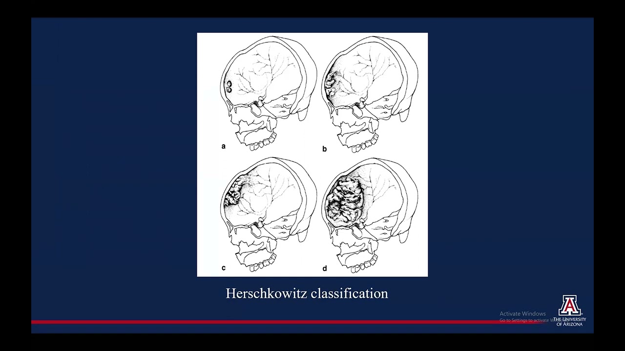 Imaging Characteristics of Hyperostosis Frontalis Interna