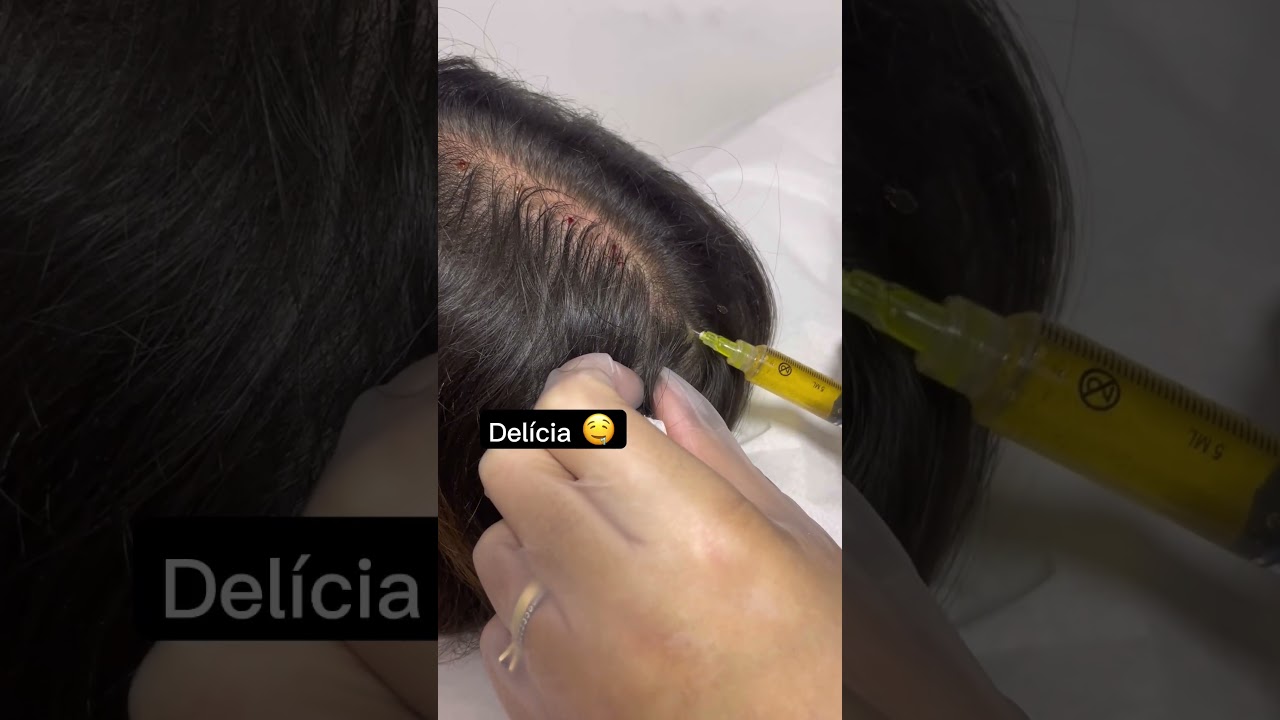 Tratando a queda de cabelo!  Aplica&ccedil;&atilde;o de plasma no couro cabeludo 💫😷