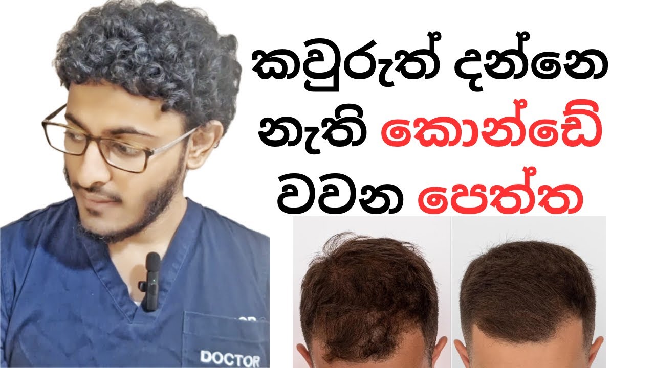 කොණ්ඩෙ වැවෙන්න Minoxidil පෙත්ත | Oral Minoxidil for Hairloss - Sinhala