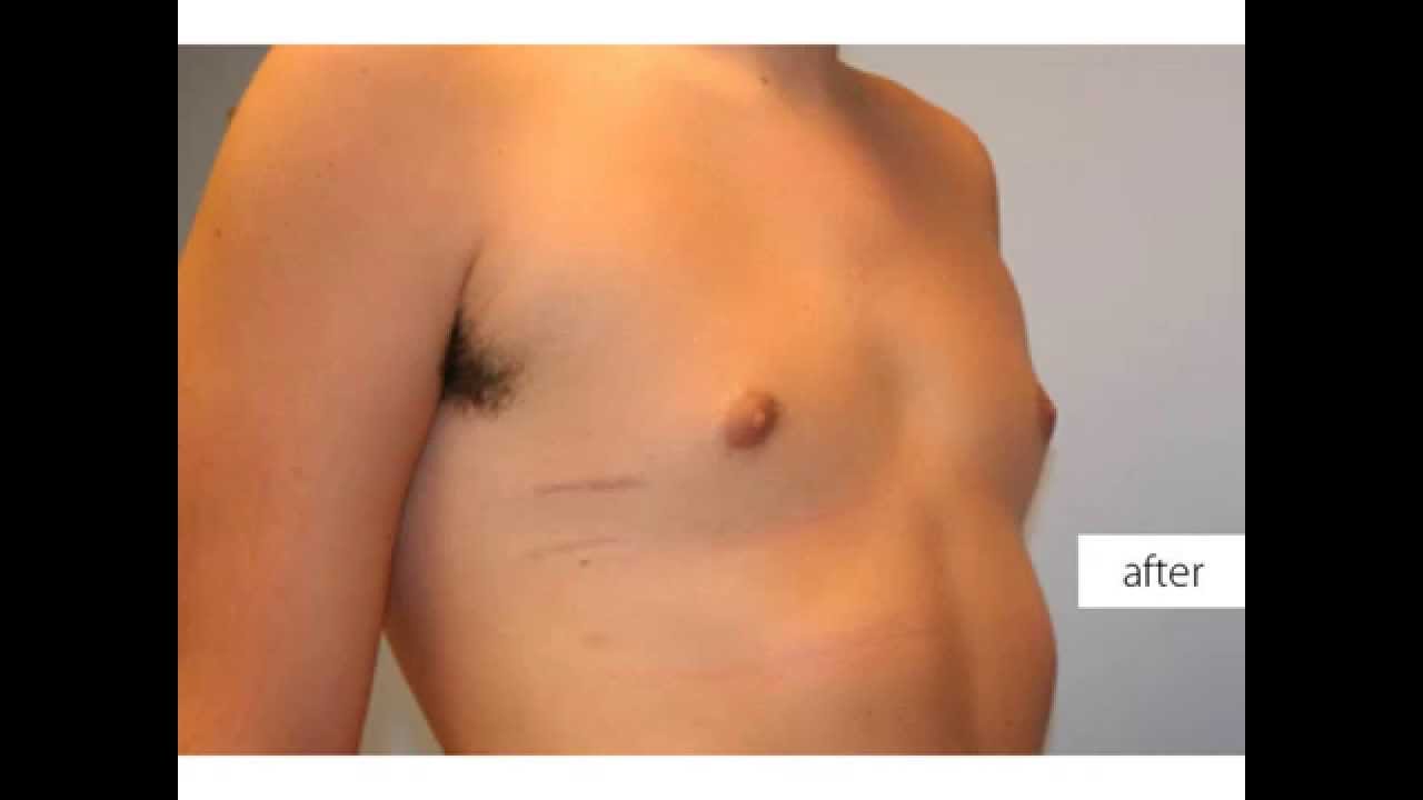 Before and After Photos of Nuss Procedure Patients
