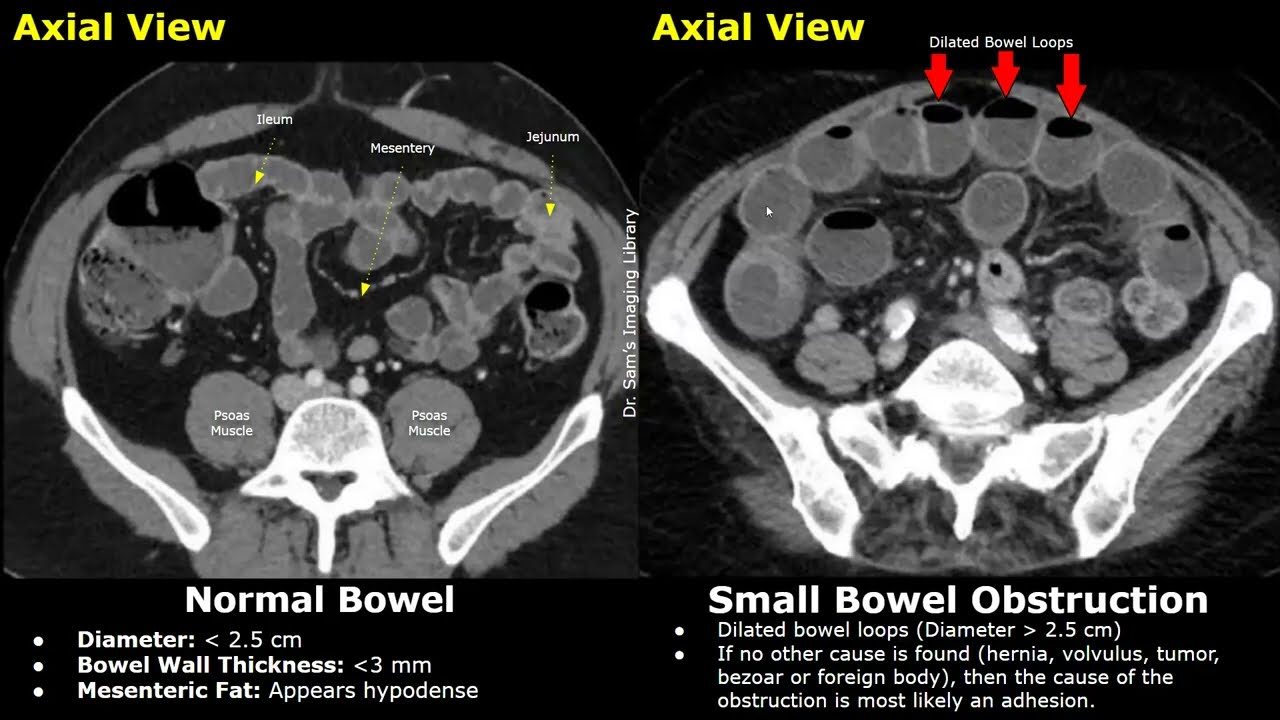 CT Abdomen Normal Bowel Vs Small Bowel Obstruction | Adhesions, Volvulus, Hernia & Other Causes