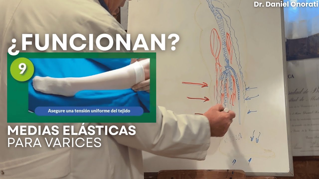 ¿Funcionan las medias de compresión para las várices? Explicación completa