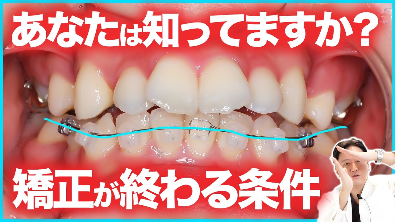 正中がずれたまま終了？ワイヤー矯正で矯正装置が外れる基準・矯正期間について【審美歯科 歯列矯正 歯並び】