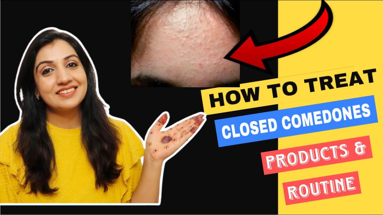 Skincare Routine for CLOSED COMEDONES|| How to treat Whiteheads, Texture, Milia? Comedones Skin