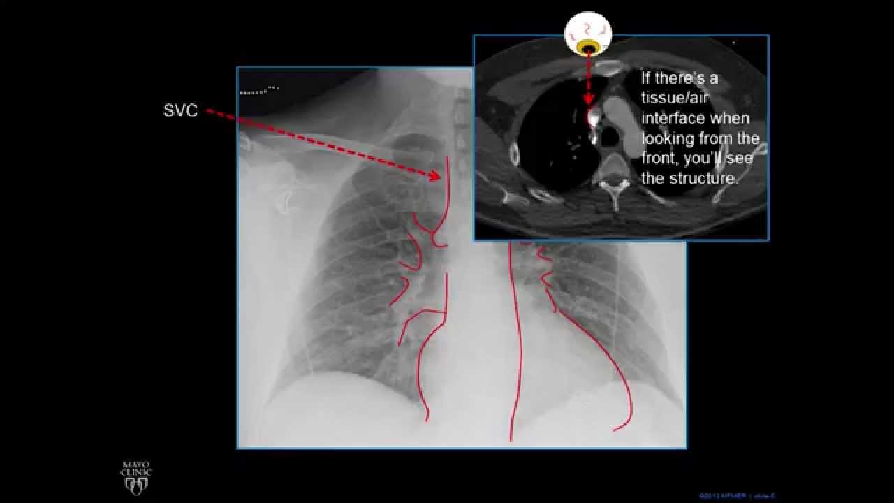 Plain Film Cardiac and Vascular Anatomy - Frontal Radiograph - Philip Araoz, M.D. - Part 1 of 10