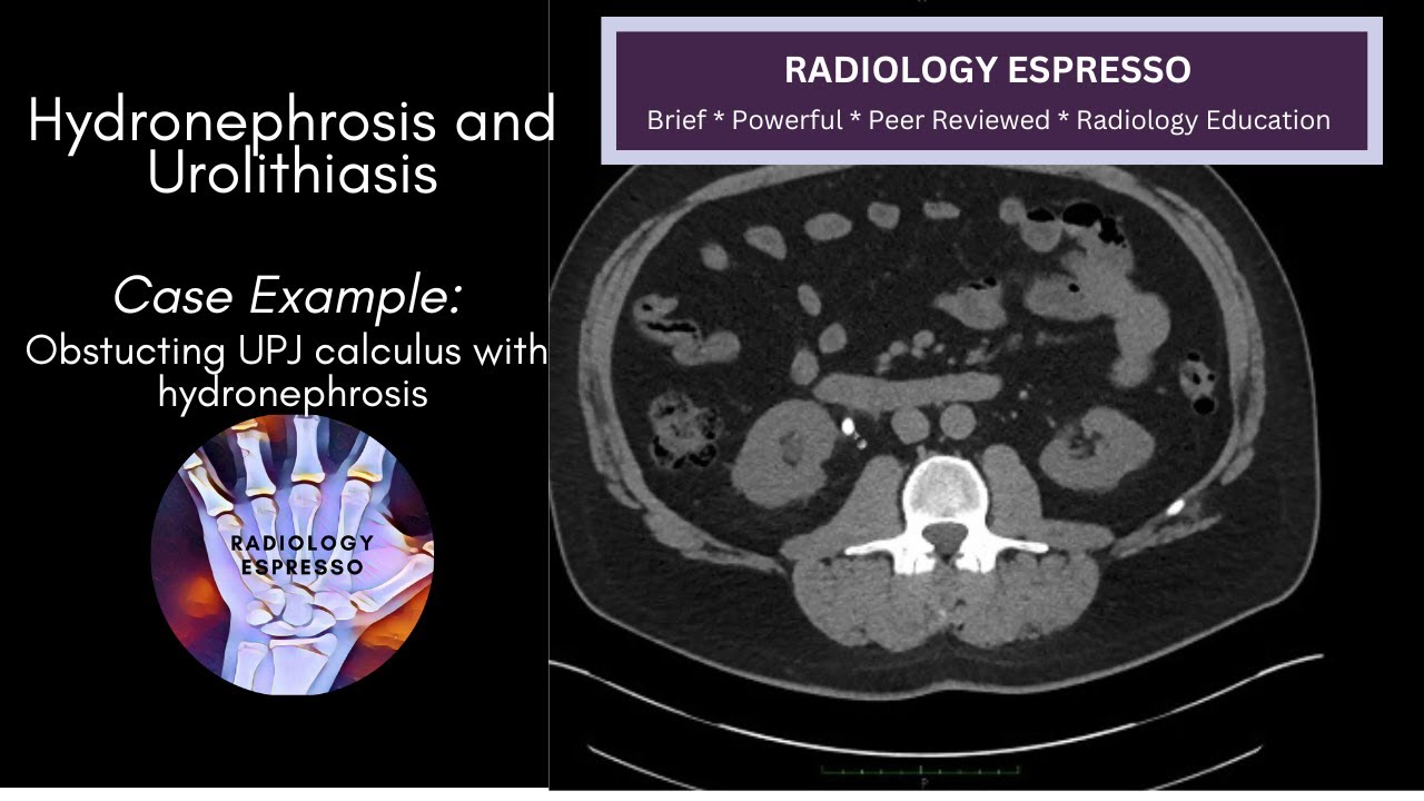 HYDRONEPHROSIS AND UROLITHIASIS: Case Example - Obstructing UPJ calculus with hydronephrosis (6310)