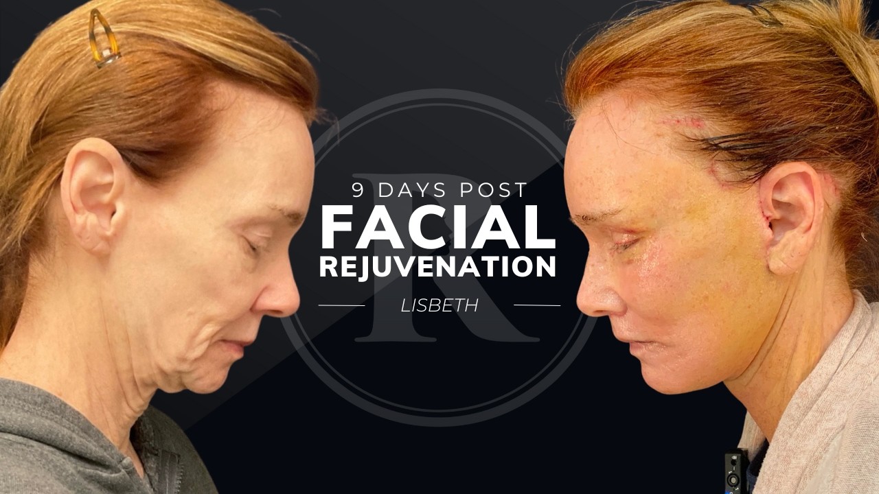Lisbeth's Story: 9 Days Post Facial Rejuvenation