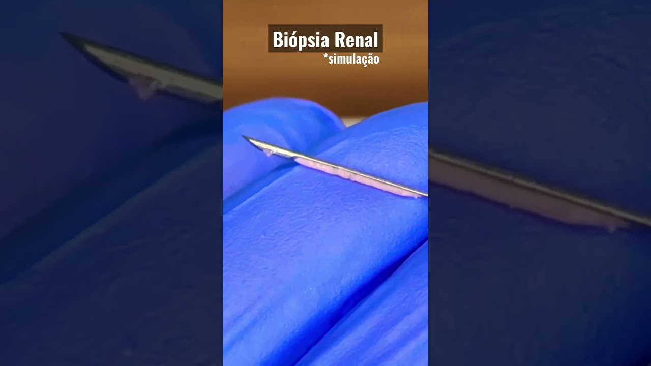 &Eacute; s&oacute; um PEDACINHO de RIM | #shorts #biopsia #rim