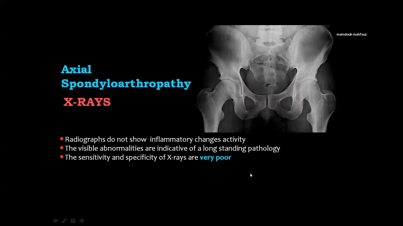 MRI Sacroiliac joints Prof. Mamdouh Mahfoz ا. د. ممدوح محفوظ مبادرة ياللا نذاكر روماتولوجي