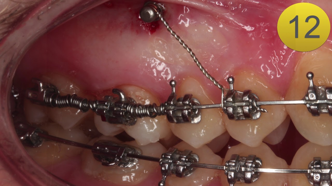 Técnica Distalamiento Molar Minitornillo