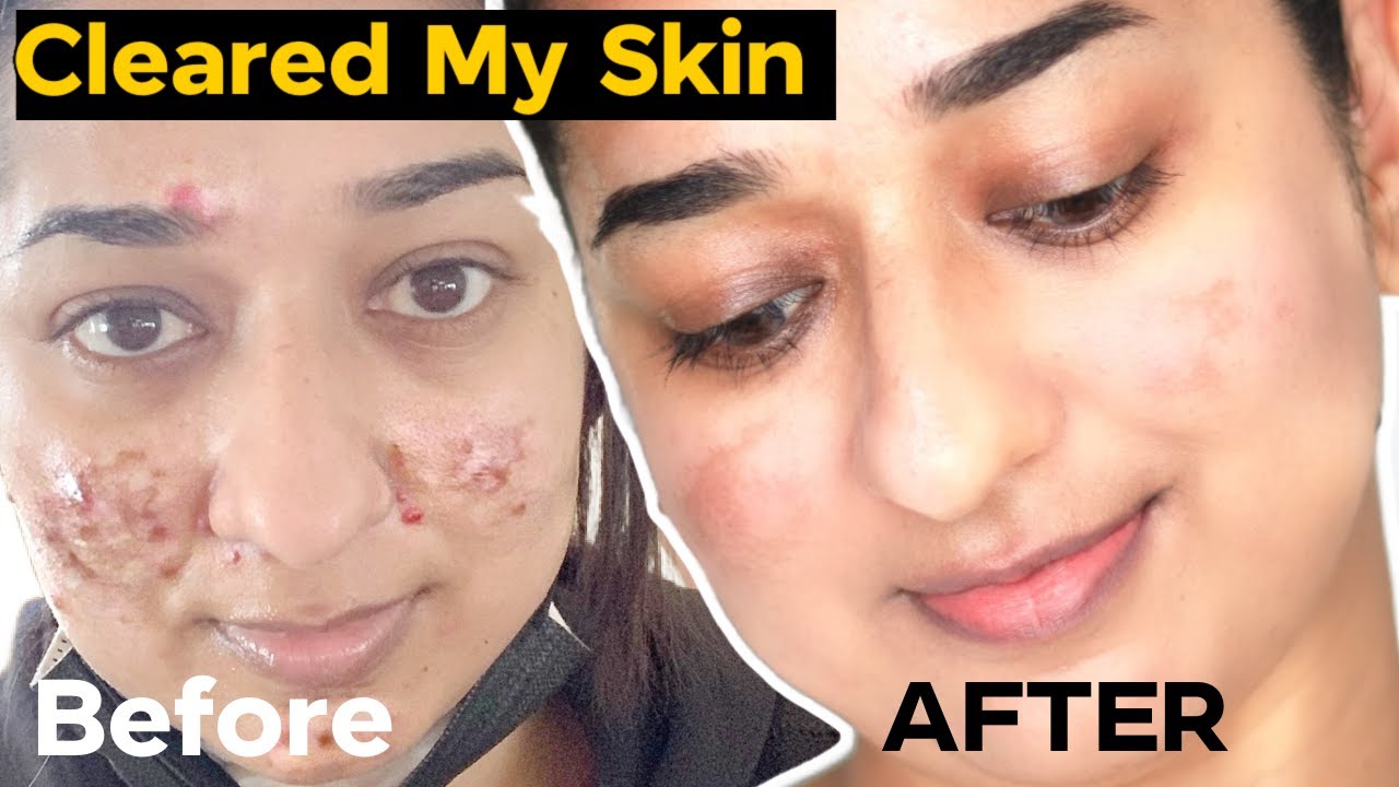 HOW I CLEARED MY ACNE , TEXTURE & HYPERPIGMENTATION ✅ FINALLY SOMETHING WORKED ✅