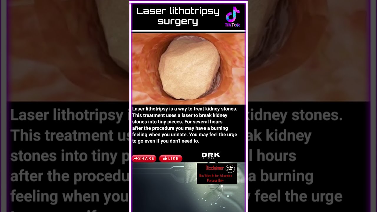 Laser lithotripsy