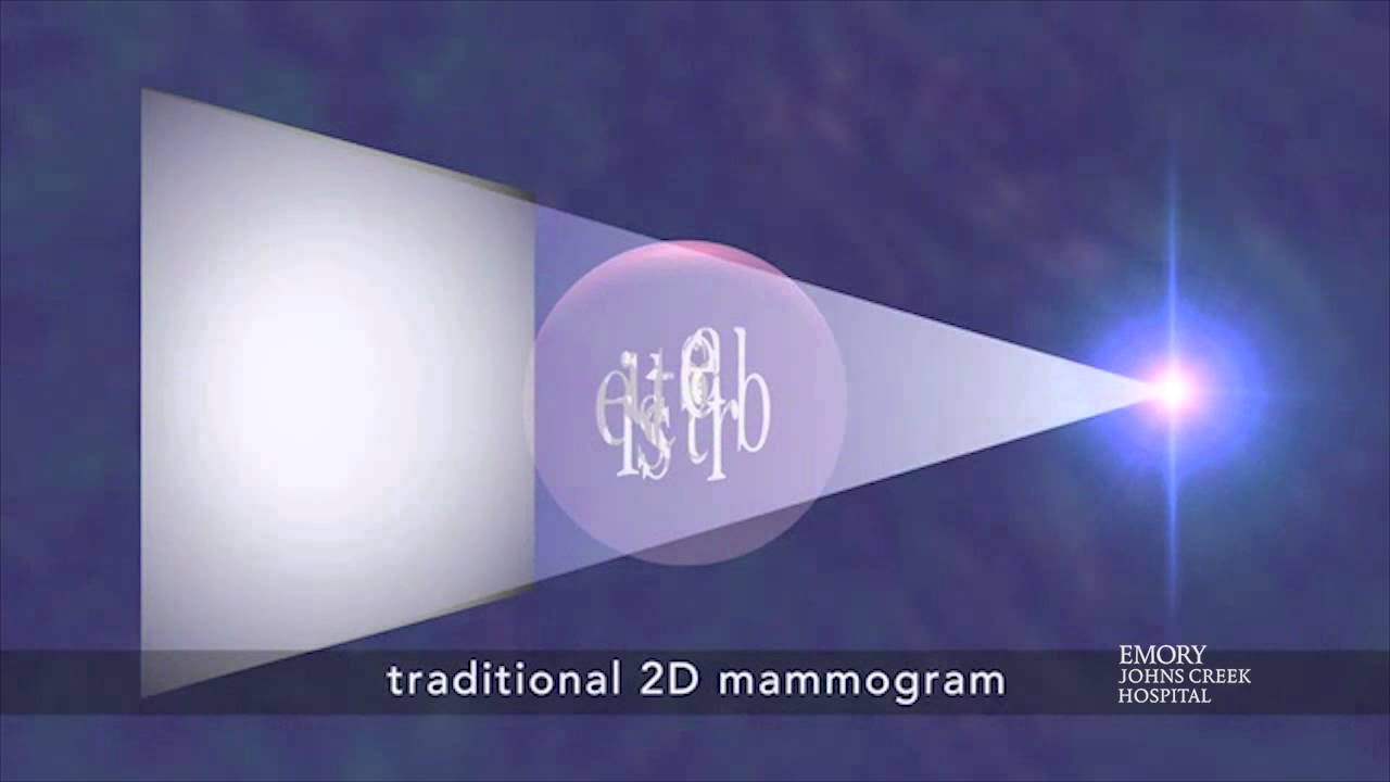 Tomosynthesis / 3-D Mammogram a New Breast Imaging Technique