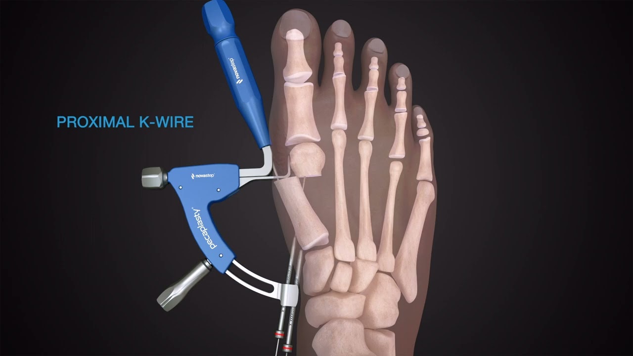 Minimally-Invasive Bunion Correction Surgery | Kansas City Direct Care Podiatrist