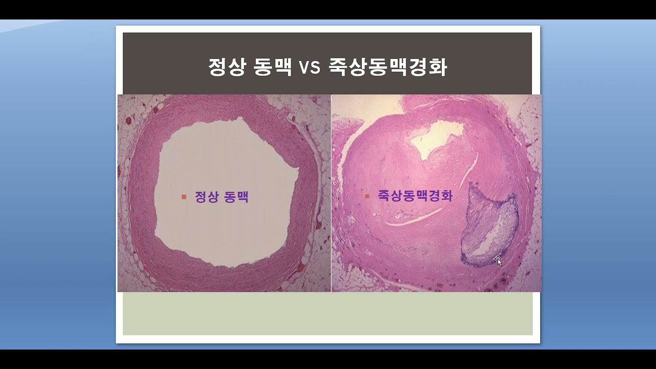 고혈압1원인(자연의학(기능의학), 동양의학(한의학) 관점)