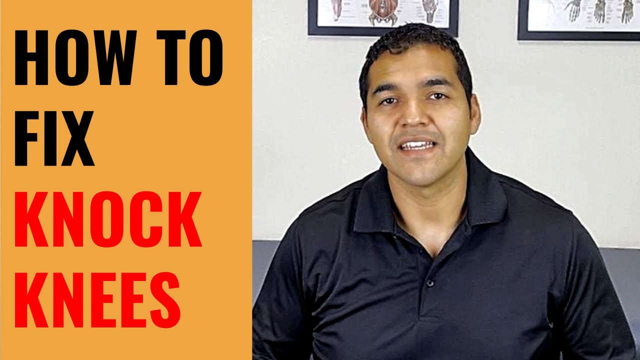How to Fix Knock Knees With 3 Simple Exercises