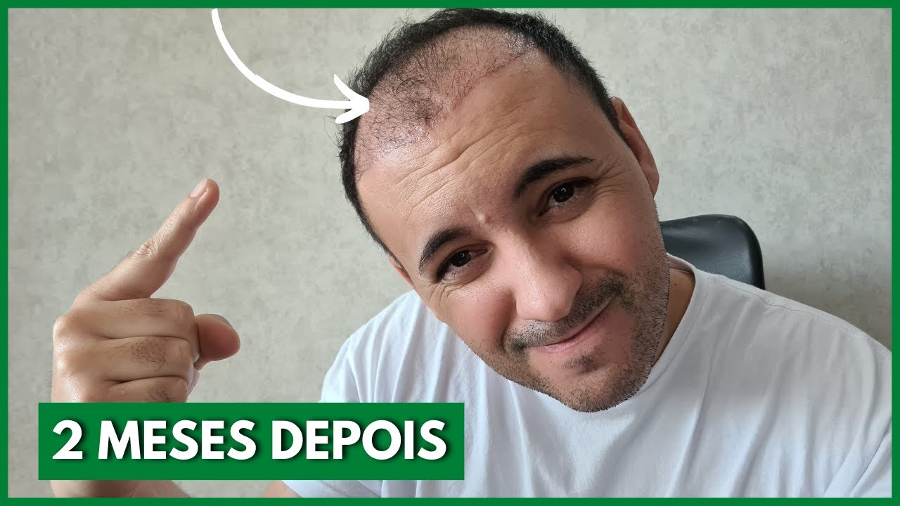 2 MESES APÓS O MEU IMPLANTE CAPILAR O QUE DEU ERRADO