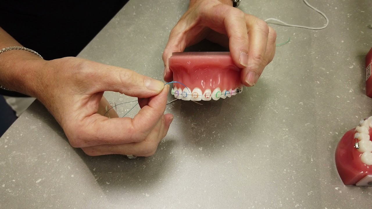 Comment passer la soie dentaire avec les boitiers orthodontiques